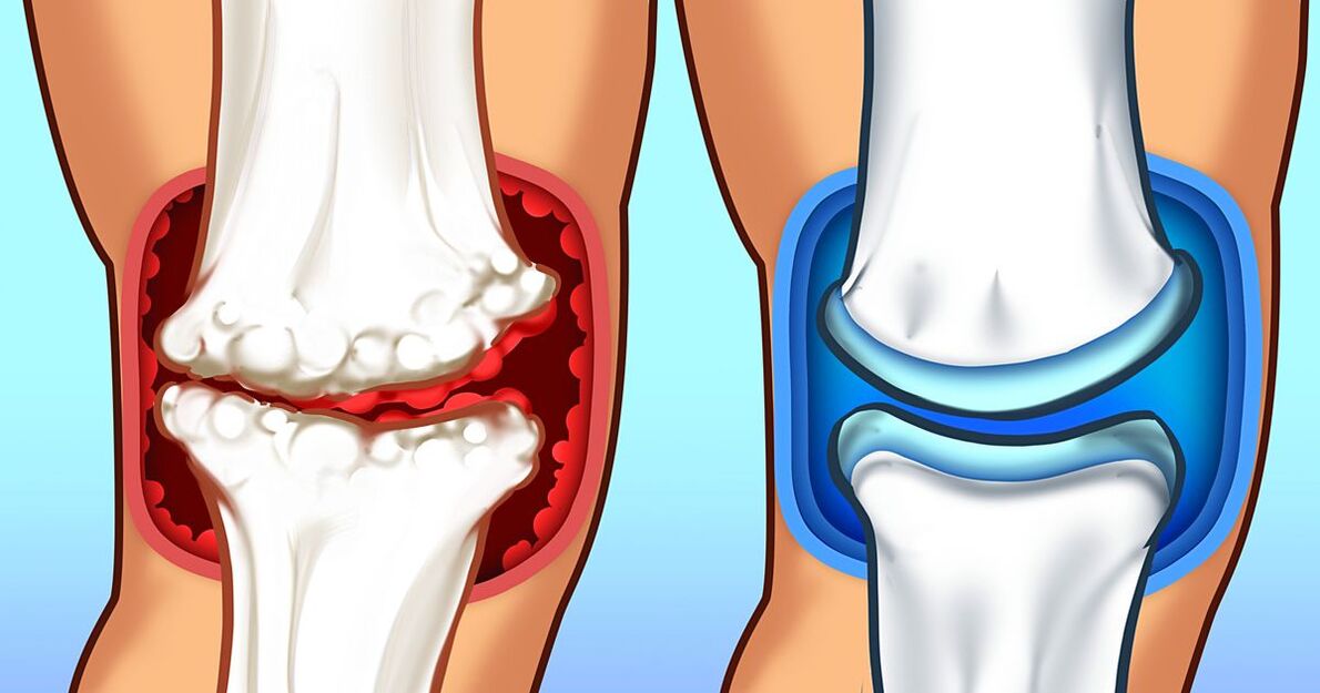 Hondrox repair cartilage tissue and its interlayer