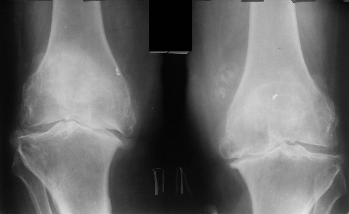 Knee x-ray with joint disease