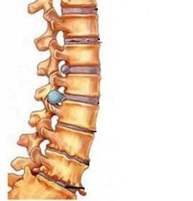 How osteochondrosis develops in the cervical area