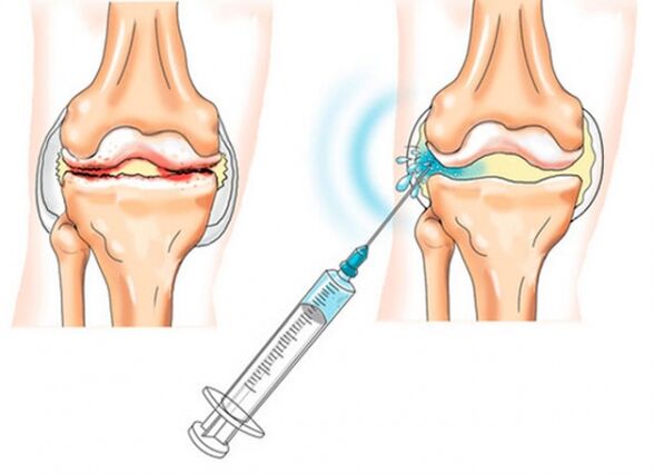 Intra-articular injection for knee joint disease