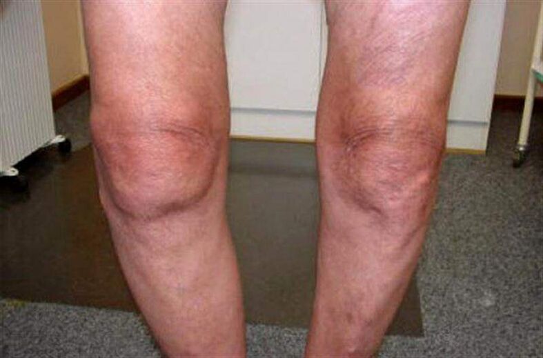 Knee swelling due to arthritis