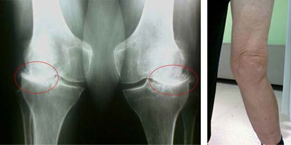 knee osteoarthritis x-ray