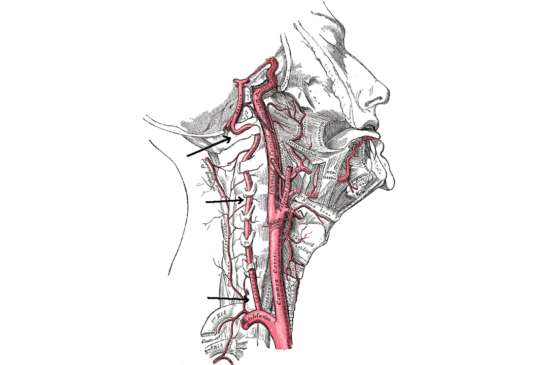 Cervical osteochondrosis compresses vertebral artery