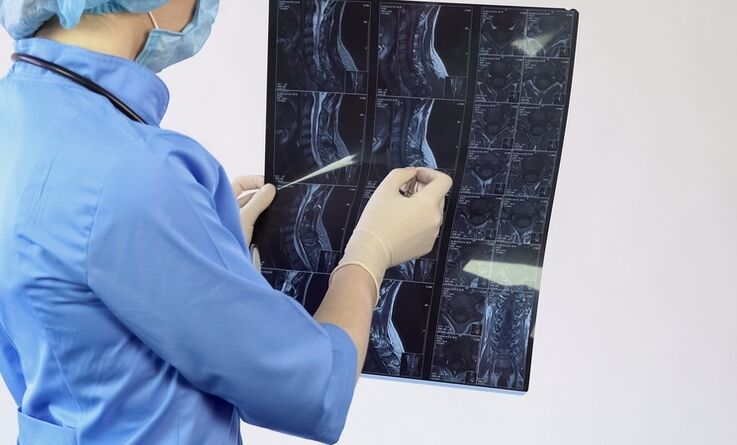 Diagnosis of cervical osteochondrosis is based on MRI
